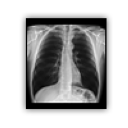 Chest xray